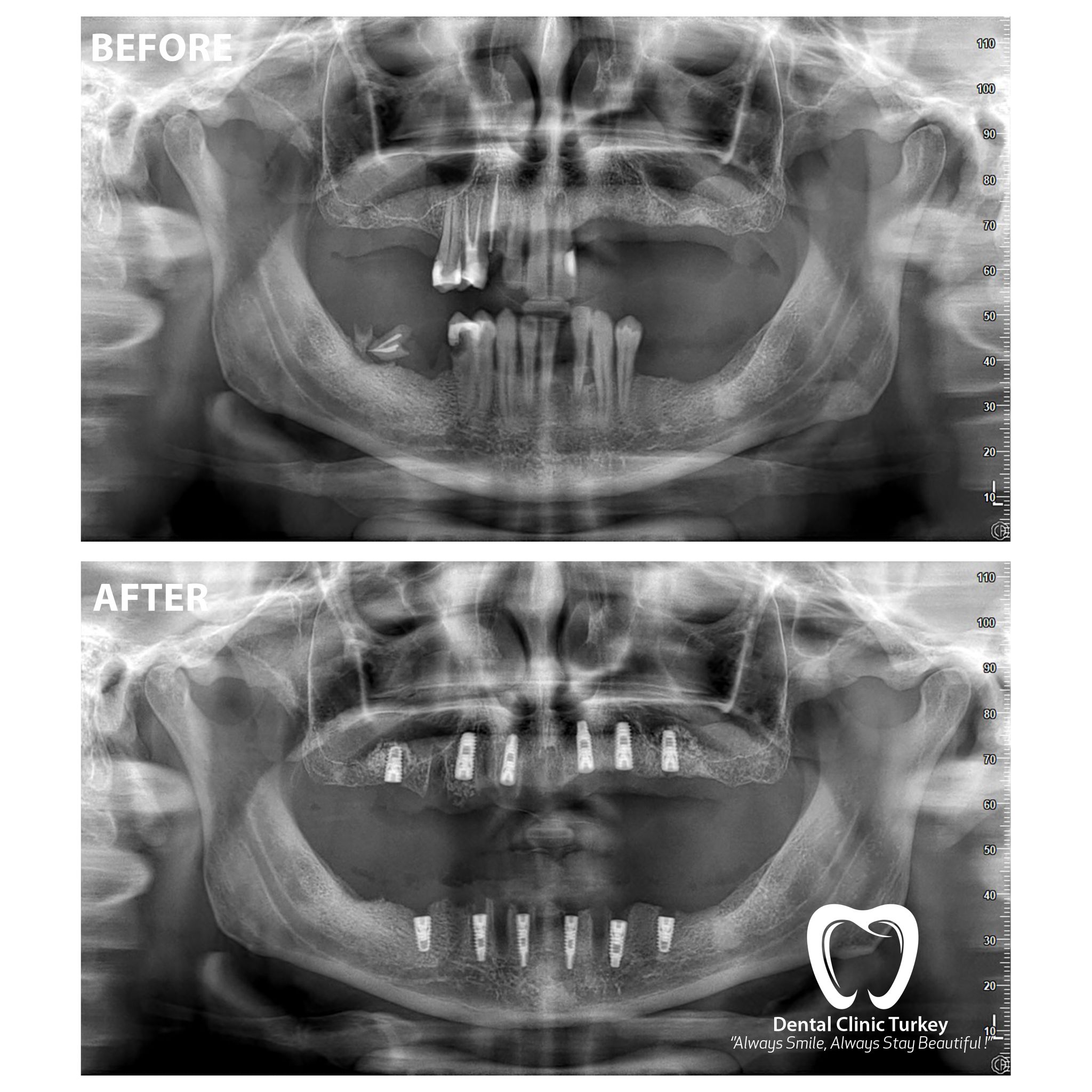 What Is Panoramic X-Ray? Antalya Dentist, Turkey Dental Clinic