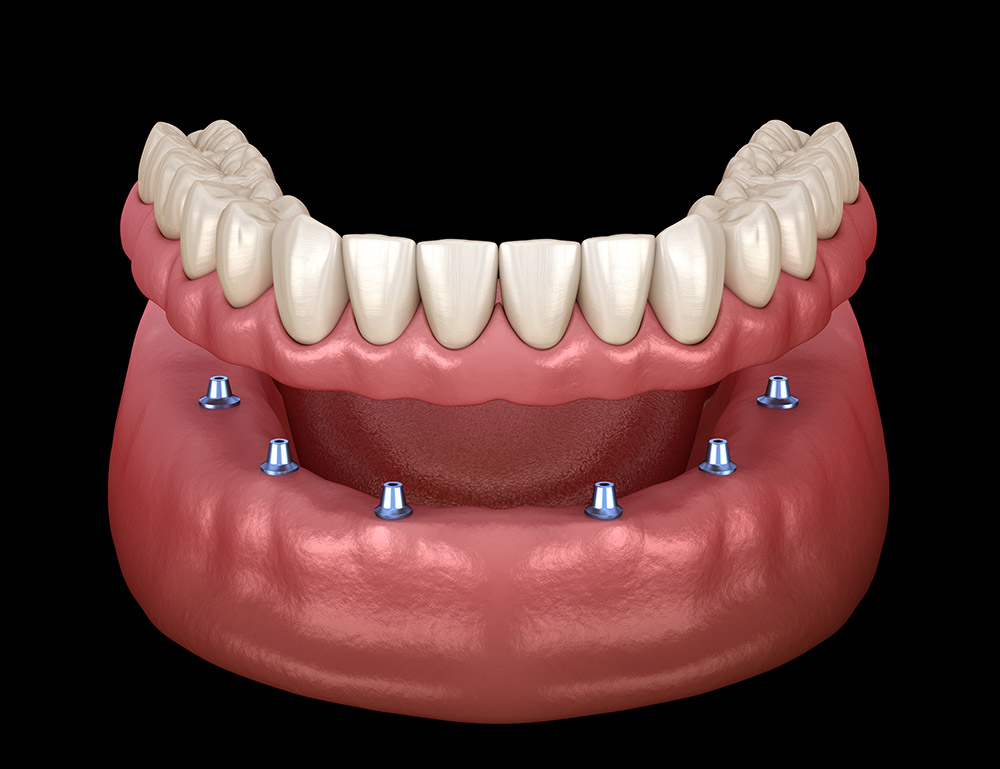 Full Mouth Implant Packages Turkey Implant Prices