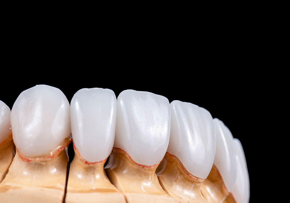 Full Set of Veneers and Crowns- Dental Clinic Turkey