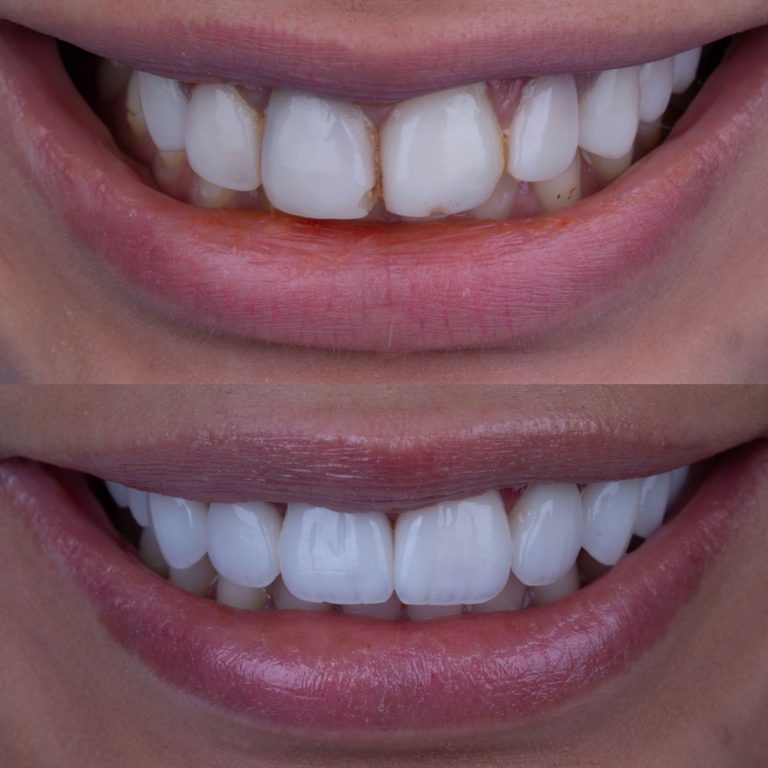 Implant Veneers Crown Prices Turkey Dental Clinic Antalya